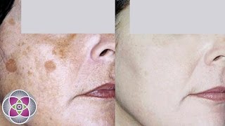How to Get Rid of Dark Spots and Age Spots on Face