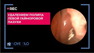Рассечение синехий полости носа с удалением полипа левой гайморовой пазухи