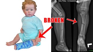 Reborn Toddler Gary Broke His Leg and Gets a REAL CAST!