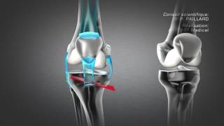 Osteotomie Tibiale de Valgisation