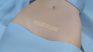 Three Steps for Post-Operative Care Video