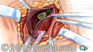 Education Hernia Repair Inguinal (Open) PreOp® Patient Surgery