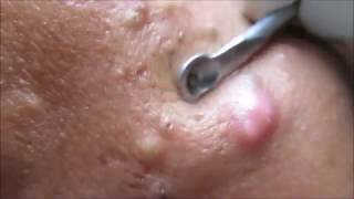 After A Long Time Comedone Extraction Video