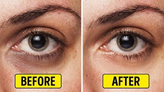 In 7 days remove dark circles under eyes permanently naturally and fast at home   Home remedies