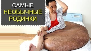 Самые необычные родинки. ТОП 5