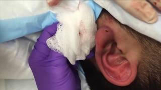 Top Five Infected Cysts and Abscesses, Ever!