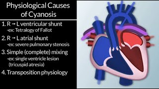 "Cyanotic Congenital Cardiac Defects: Diagnosis & Therapy" by Tom Kulik, MD, for OPENPediatrics