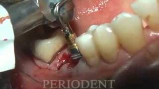 Immediate Dental Implant Placement