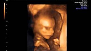 Ecografia 4D embarazo de  19 semanas  Clinica Ginecologica Dr. Rafael Ortega Muñoz Ciudad Real