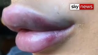 YouTuber's cosmetic surgery disaster