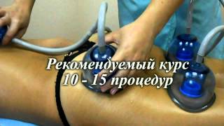 Вакуумно-роликовый массаж на аппарате Старвак.
