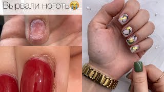 ВЫРВАННЫЙ ноготь. Делаем эстетику. Маникюр с абстракцией на клиенте.