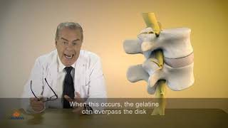 Herniated disk - STAR BRACE® DYNAMIC FIX