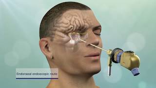Keyhole Brain Tumor and Skull-Base Surgery