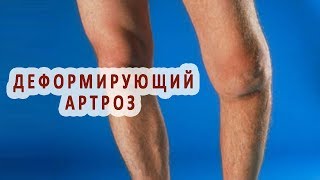 Что такое деформирующий артроз и как его лечат?