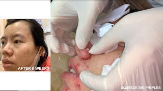 Dermatologist treating squeeze pimples, whitehead blackhead, pustule, anti acne after 6 weeks nose