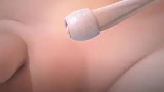 #Orchiopexy is a surgery to move an undescended testicle in a newborn baby into the scrotum