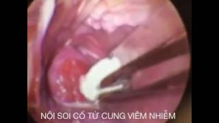 Nội Soi Cổ Tử Cung Viêm Nhiễm Phụ Khoa