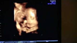 Perfect 4D 27 Week Scan Baby Beautiful Face - Julie
