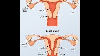 Woman discovers she has TWO wombs and TWO cervixes after routine smear test
