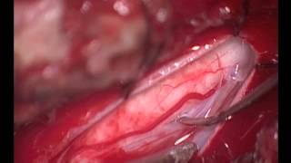 Syringopleural shunting