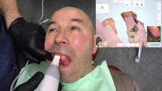 Dr DUMINIL / Empreinte optique et prothèse implanto-portée / Vidéo 1