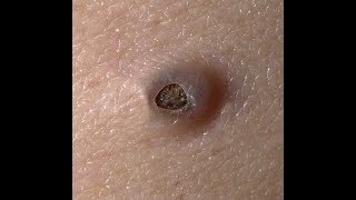 Удаление огромной черной точки