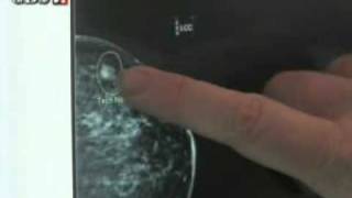 Breast Cancer Awareness for Men