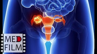 Рак шейки матки (немой вариант) © Cervical cancer (soundless)