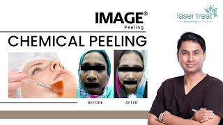Chemical Peeling | কেমিকাল পিলিং | ত্বকের উজ্জ্বলতা বৃদ্ধির উপায় | Laser Treatment in Bangladesh