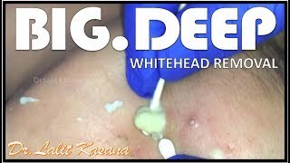 BIG DEEP WHITEHEADS AND SEBACEOUS CYST REMOVAL by Dr.Lalit Kasana