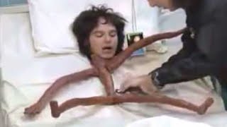 YA TUHAN GAK TEGA LIHATNYA, Inilah Manusia Paling Kurus Di Dunia