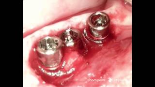 MIMI II Dental Implant Surgery - from 12 to 22