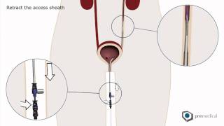 Memokath™ 051 (Ureteric) - PNN Medical