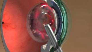 Augenoperation (Augen-OP) - Kernrotation Animation