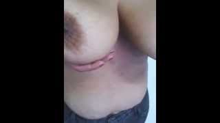 Breast hypertrophy
