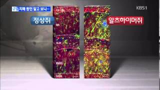 알츠하이머, 신경세포 억제 물질 때문