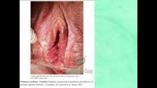Sexually Transmitted Diseases Pictures