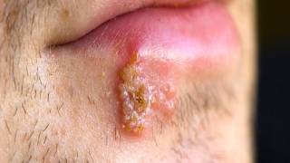 What is HSV-1? (Beauty & Grooming Guru)