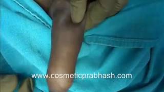 Penis Enlargement India Small Penis Fat Grafting Surgery Delhi Dr Prabhash.