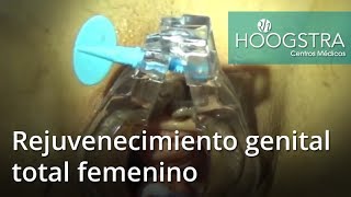Rejuvenecimiento genital total femenino (18190)