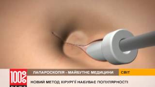 Хирургия почти без разрезов