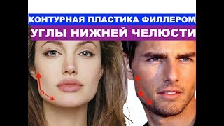Углы нижней челюсти / Пластика филлером / Dr Rinat Sitanovich