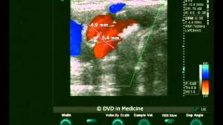 Carotid & Vertebral Arteries Ultrasonic Evaluation