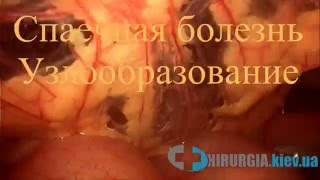 Лапароскопия при спаечной болезни