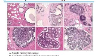Clinical Pathology Lecture - Breast Disorders