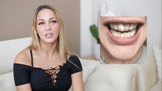 DrSmile Stories: Aylin zog Aligners Veneers vor