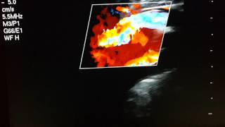 Deep vein trombosis Тромбоз подколенной вены