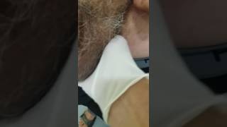 Hydrocele