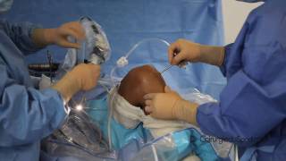 DIDT TLS : chirurgie du ligament croisé antérieur (LCA) au didt système TLS ou DT4-TLS